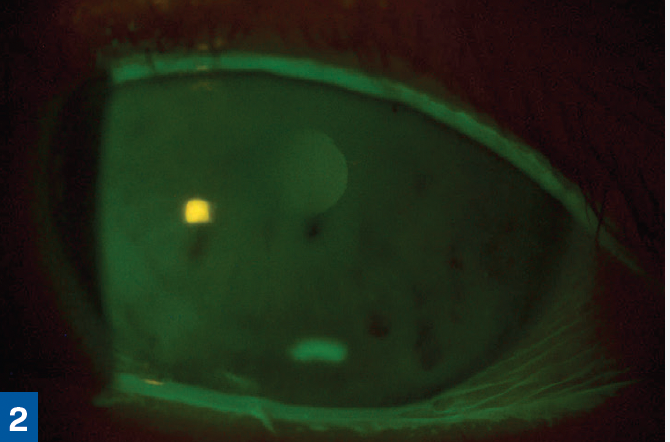 CASE STUDY: A 68-year-old White woman was referred for persistent keratitis OS and failure on multiple medications. 