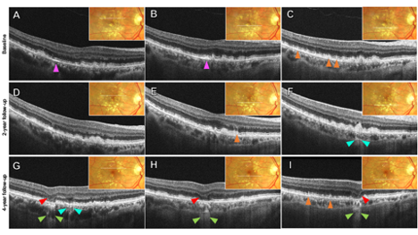 Figure 2. Optical coherence tomography biomarkers and features of geographic atrophy in the right eye showing progression over 4 years. Color fundus photo insets show OCT B-scan location (white line). Baseline: A, B, C. 2-year follow-up: D, E, F. 4-year follow-up: G, H, I. Left
column: Hyperreflective crystalline deposit (pink arrowhead) progresses to cRORA within 4 years. cRORA is denoted by outer plexiform and inner nuclear layer subsidence (red arrowhead) and choroidal hypertransmission (green arrowheads). An adjacent area of photoreceptor disruption with underlying variable choroidal hypertransmission (teal arrowhead) developed nasally at the margin of another area of cRORA (not shown). Middle column: A hyperreflective crystalline deposit (pink arrowhead) progresses to cRORA within 4 years. Subsidence of the inner nuclear and outer plexiform layers (red arrowhead) and homogenous choroidal hypertransmission (green arrowheads) is appreciated at the site of cRORA. At the 2-year follow-up adjacent subretinal drusenoid deposits can be appreciated
(orange arrowhead). Right column: Large, soft drusen are seen at baseline with adjacent subretinal drusenoid deposits (orange arrowheads). At the 2-year follow-up, there is relative photoreceptor disruption overlying the drusen with underlying variable choroidal
hypertransmission (teal arrowheads) suggestive of incipient iRORA. At the 4 year-follow-up cRORA has developed with outer plexiform and inner nuclear layer subsidence (red arrowhead) and choroidal hypertransmission (green arrowheads). Adjacent subretinal drusenoid deposits (orange arrowheads) are seen temporally. cRORA: Complete RPE and outer retinal atrophy; iRORA: Incomplete RPE and outer retinal atrophy; RPE: retinal pigment epithelium (Figures courtesy of Ethan Wohlgemuth, OD)