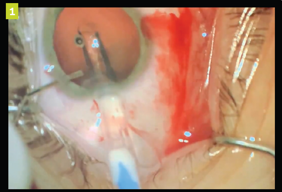 Figure 1. Implantable contact lens (ICL) injection into the anterior chamber through clear corneal incision.