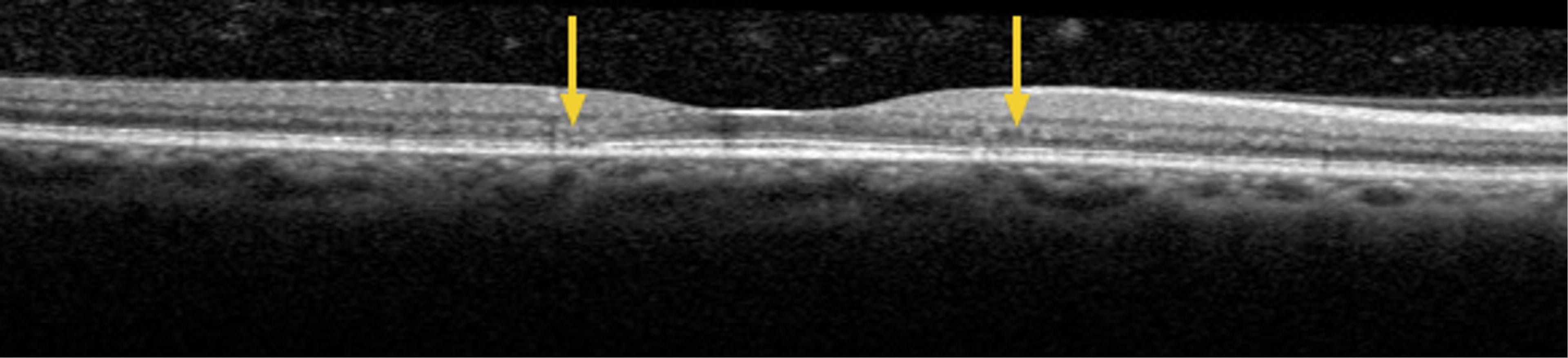 Figure 5. SD-OCT imaging of the right eye with the scan line adjusted to the area just below the fovea. Arrows point to a more obvious area of attenuation of the ELM and IS/OS line temporal to the fovea and a more subtle area of early attenuation nasal to the fovea.