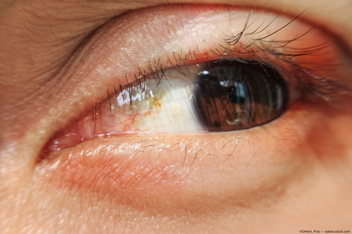 Closeup of eyelid inflammation Image Credit: AdobeStock/OHishi_Foto