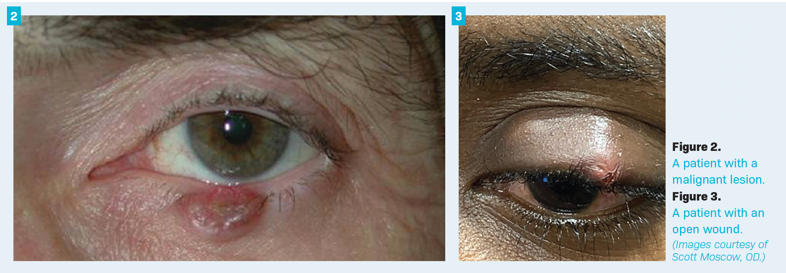 Figure 2. A patient with a malignant lesion. Figure 3. A patient with an open wound. (Images courtesy of Scott Moscow, OD.)