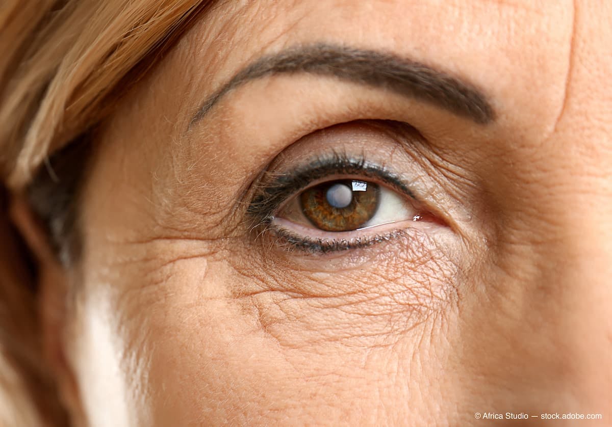 Cataract concept. Senior woman's eye, closeup (Adobe Stock / Africa Studio)