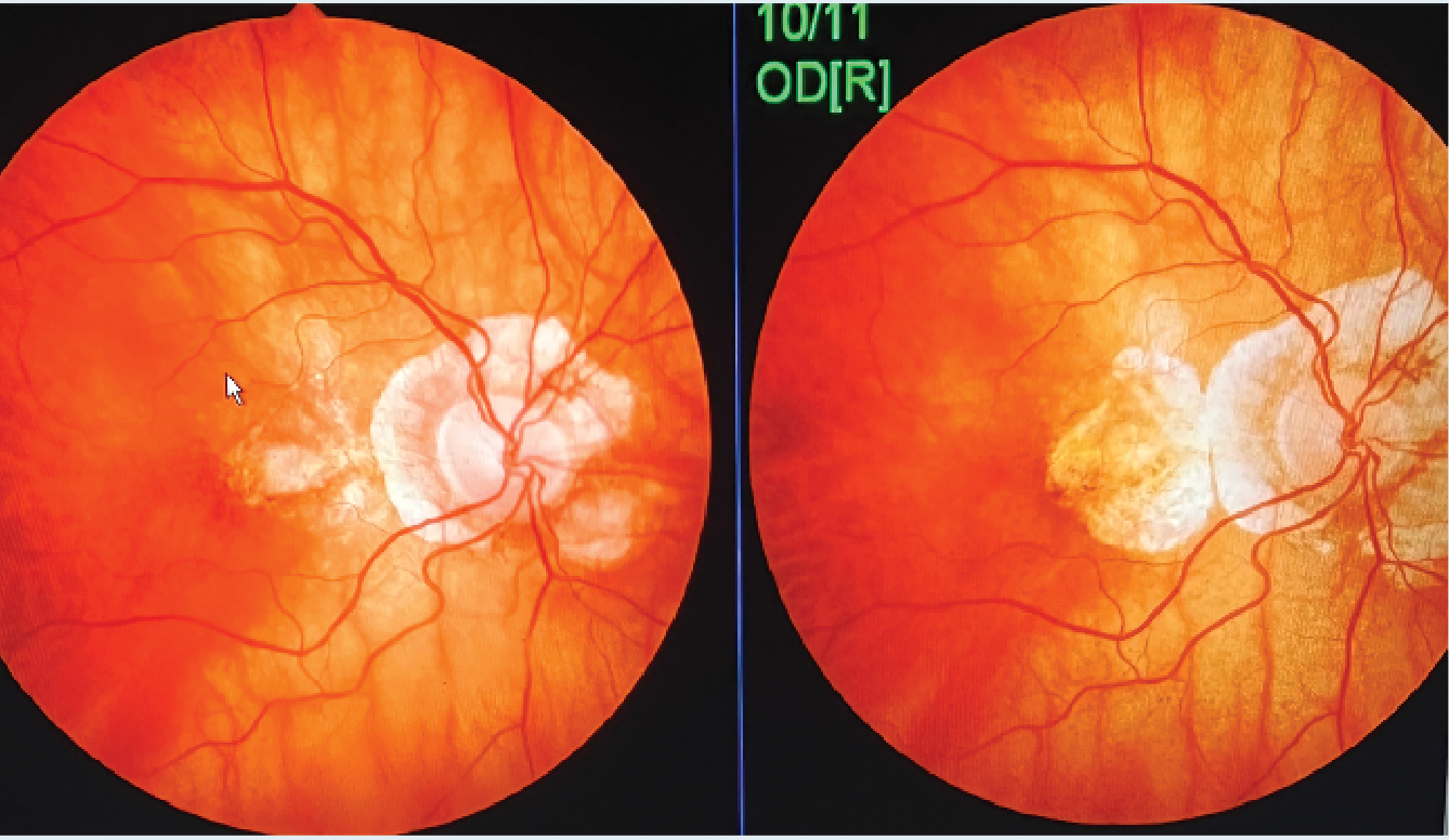 Do diabetes, diabetic retinal disease contribute to macular degeneration?