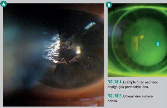10 tips to enhance scleral contact lens success