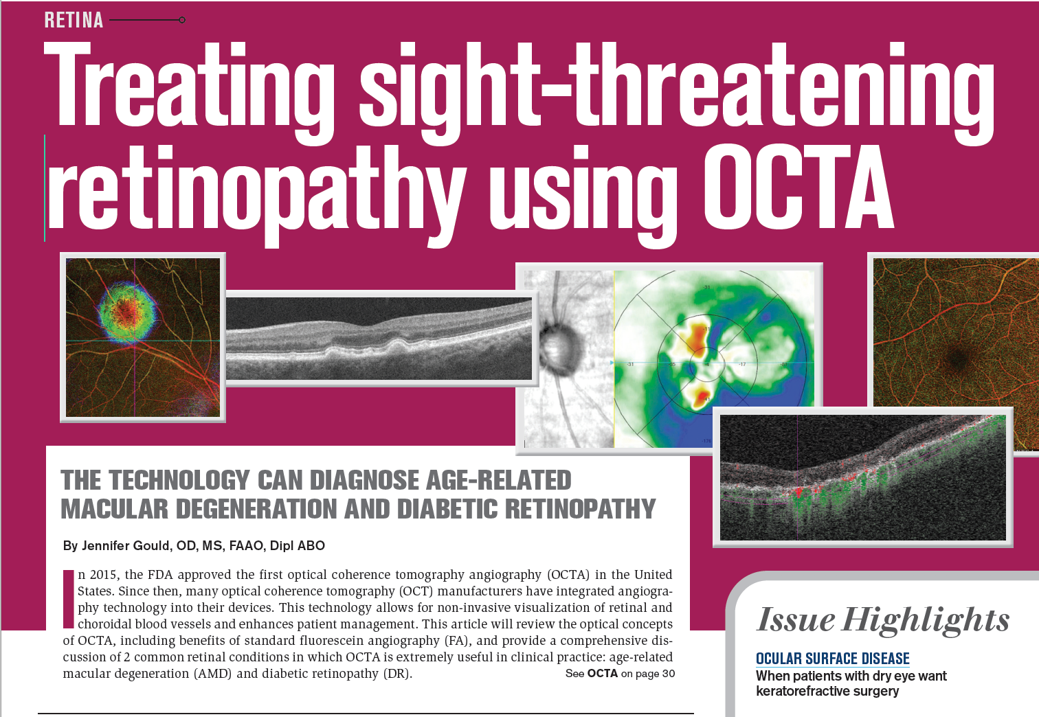 Treating sight-threatening retinopathy using OCTA