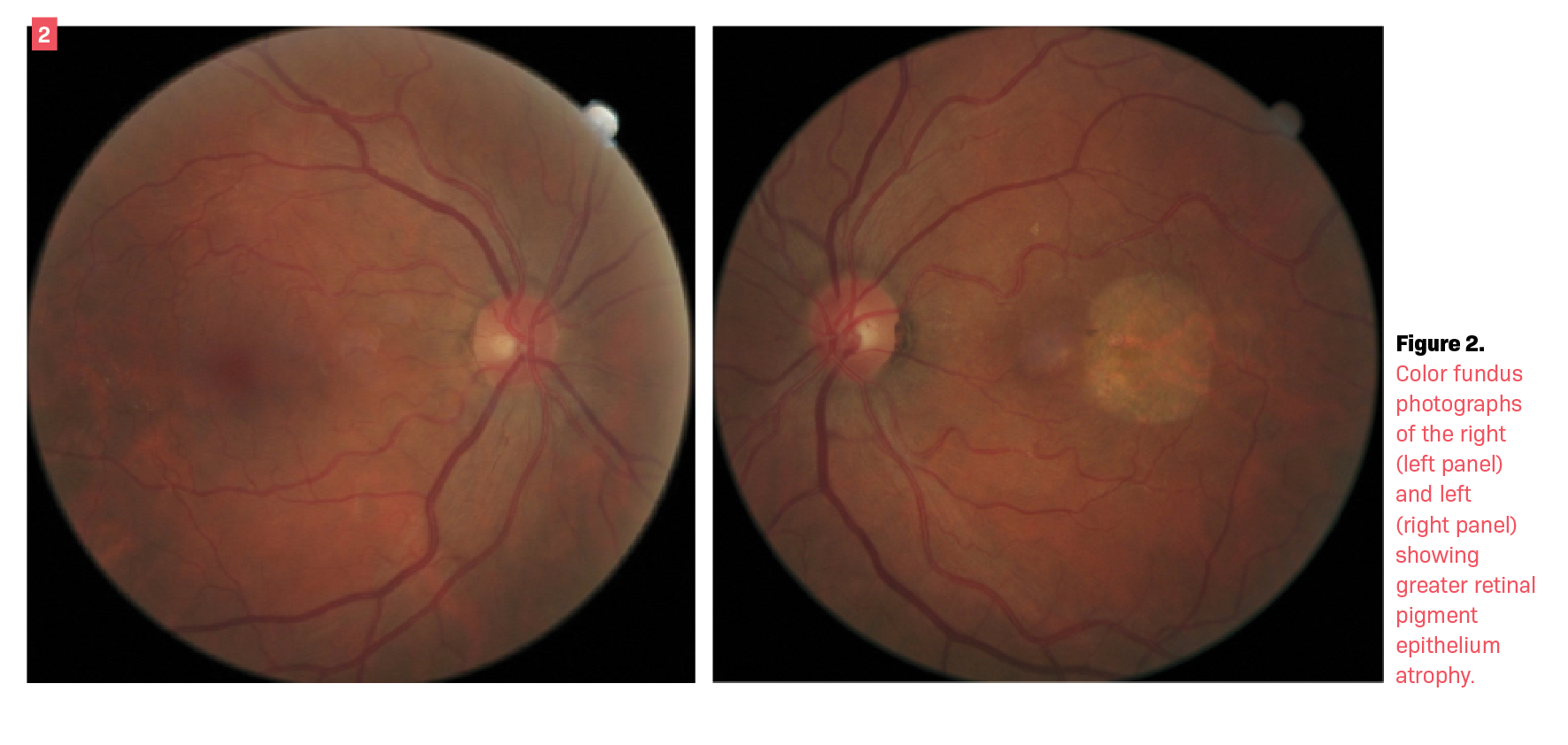 Central serous retinopathy is not a benign disease