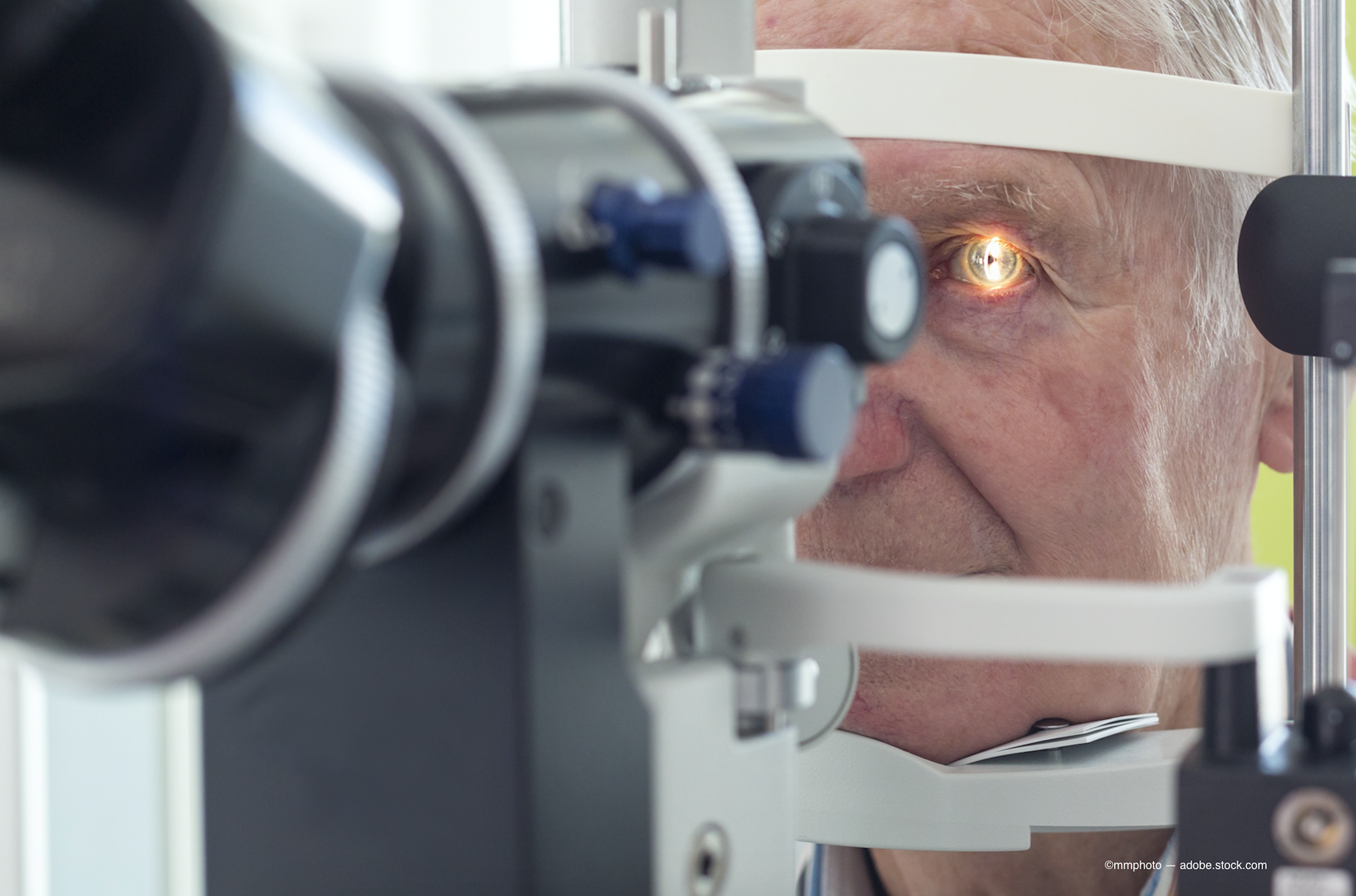 6 steps to prepare former LASIK patients for cataract surgery