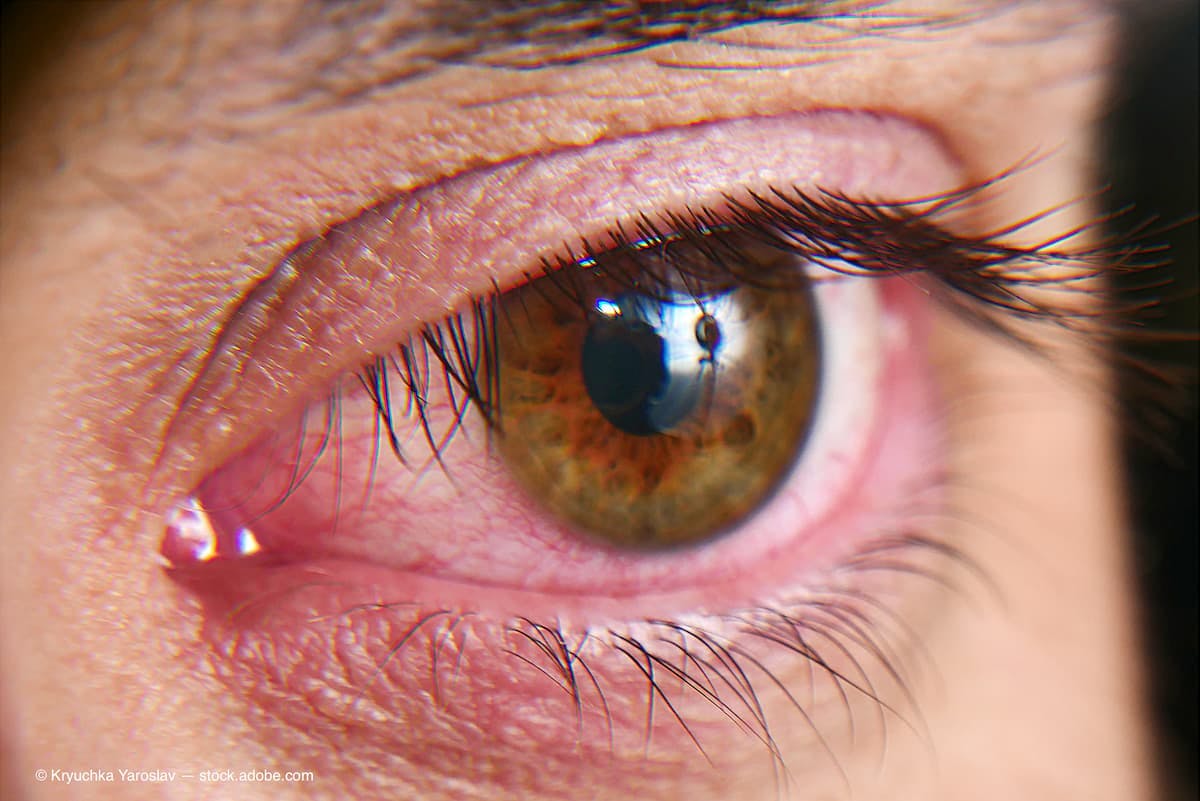 New topical therapies for dry eye disease