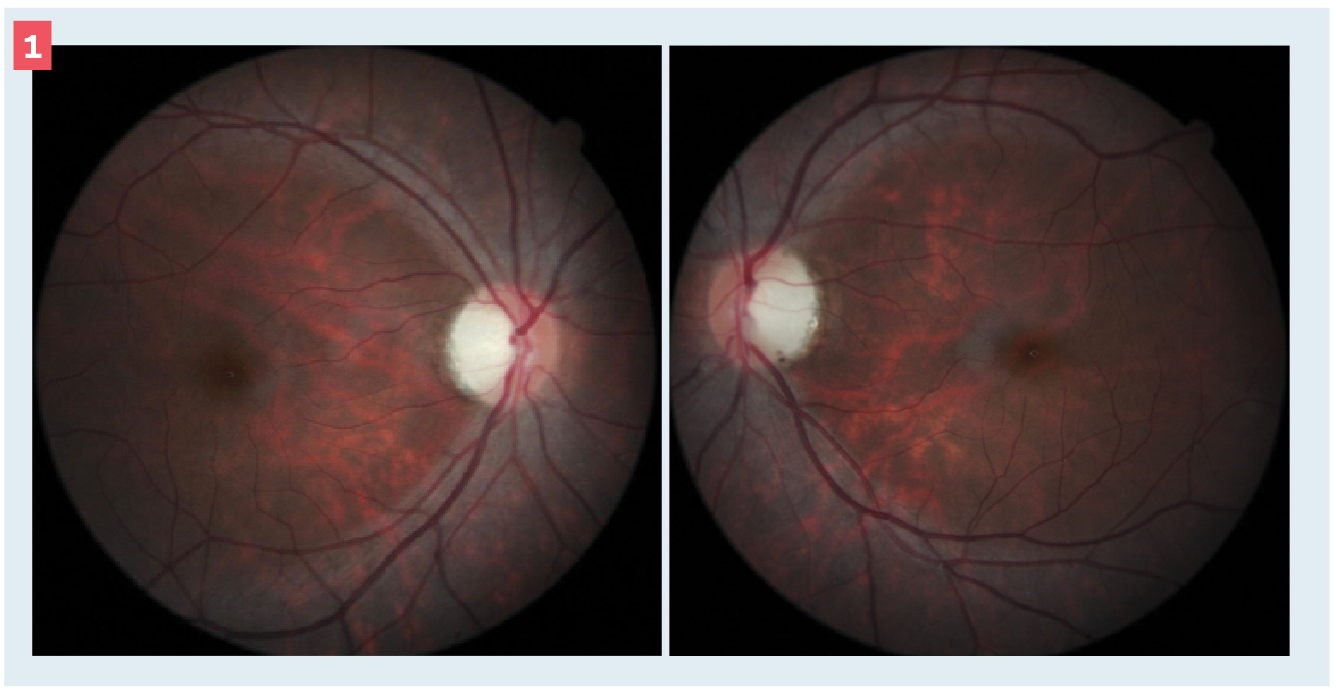 Figure 1. Color fundus photographs documenting the right and left eyes, respectively. 

The disc margins are distinct with pallor, but there is no cupping that would be consistent with glaucoma. Note that the retinal nerve fiber layer is more robust superiorly and inferiorly; in contrast, the arcuate bundles are sparse, uncovering the choroidal vessels.