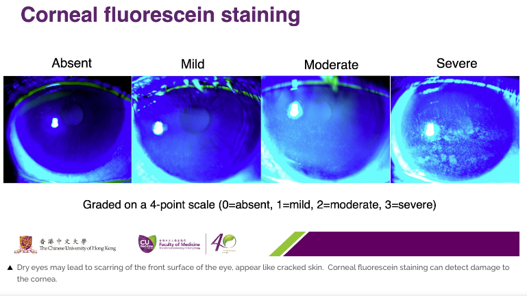 Corneal fluorescein staining