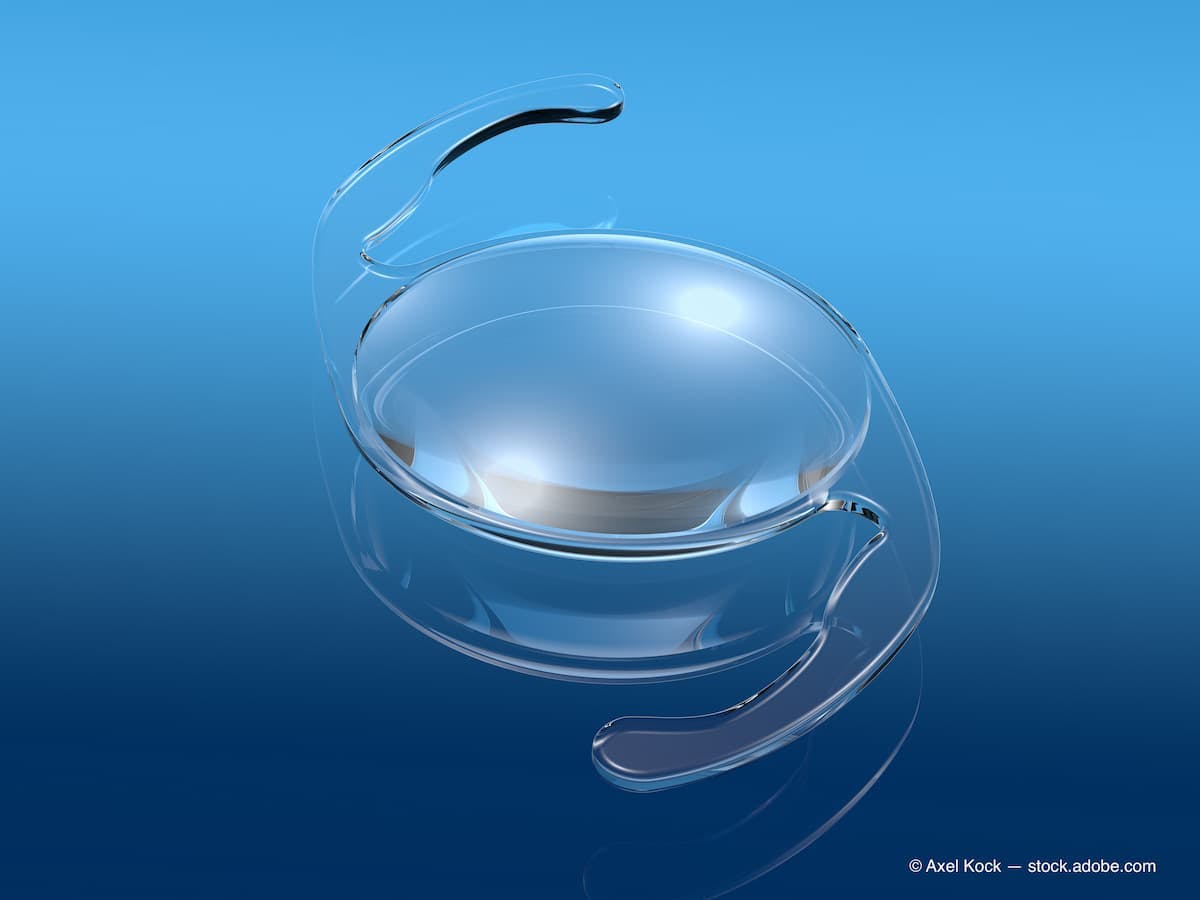 Intraocular lens (IOL) on blue background, medically 3D illustration (Adobe Stock / Axel Kock)