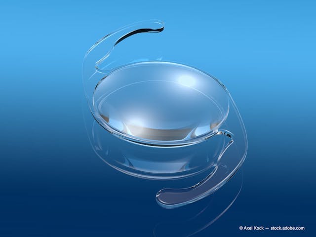 Intraocular lens (IOL) on blue background, medically 3D illustration (Adobe Stock / Axel Kock)