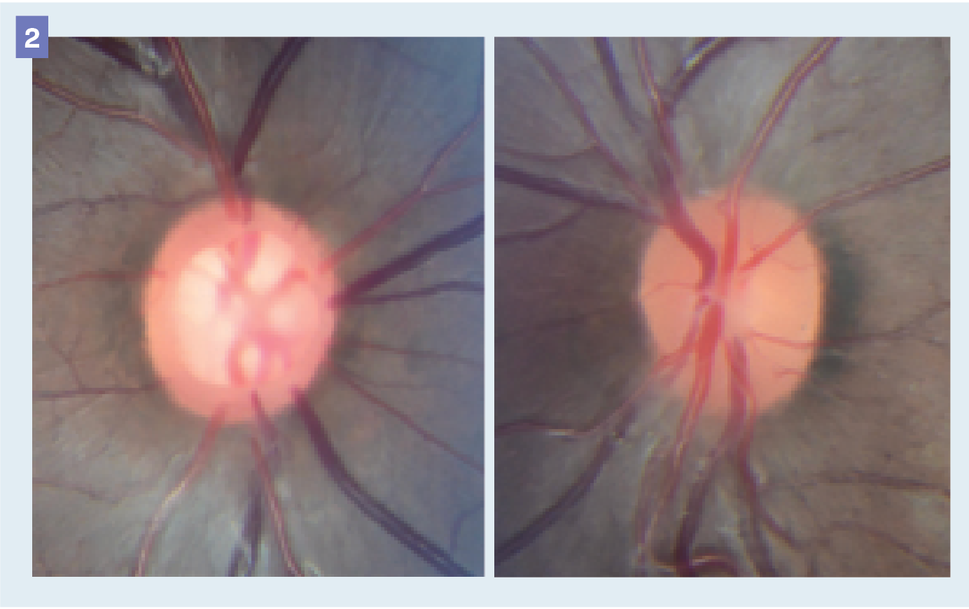 Figure 2. Pediatric Uveitic Glaucoma. Uveitic glaucoma showing asymmetric cup to disc ratio in a 13-year-old female patient. (Images courtesy of Samantha Rosen, OD)