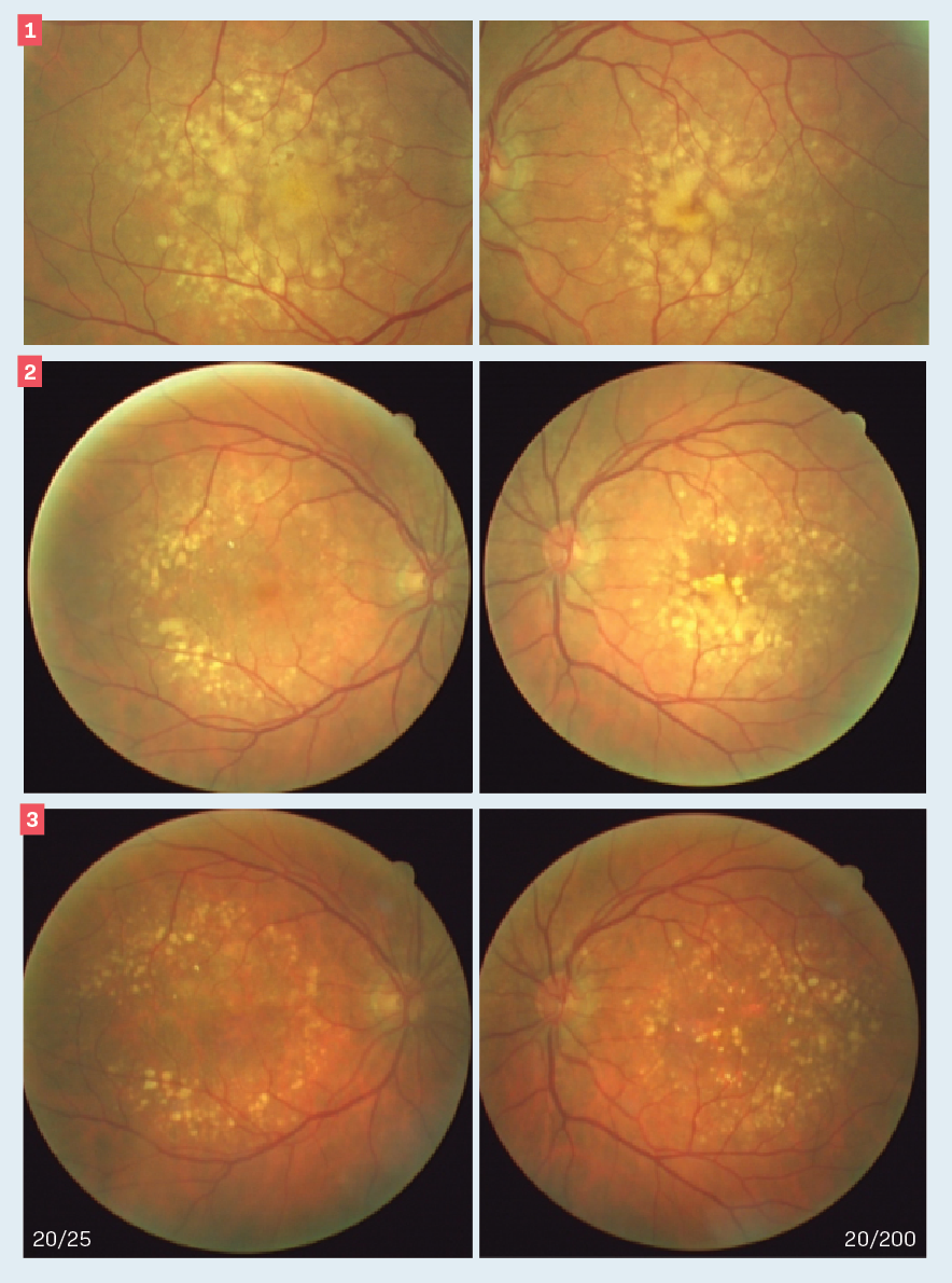 Figure 1. Baseline color fundus photographs of the right (L) and left (R) eyes. Note that there is a small area of healthy-looking macula in the right eye accounting for the visual performance. Figure 2. Baseline plus 2 years color fundus photographs of the right (L) and left (R) eyes. Note that the drusen patterns of each eye have changed. In the right eye, the drusen appear to have regressed further, sparing the center of the macula. The left eye shows enlargement of drusen as well as atrophy of the retinal pigment epithelium, especially involving the macula. Figure 3. Baseline plus 8 years color fundus photographs of the right (L) and left (R) eyes. Note that there is considerable maturation of the drusen pattern of the right eye accompanied by retinal pigment atrophy with sparing of the macula. The left eye shows considerable involvement of the center of the macula with drusen and retinal pigment epithelial atrophy. 

(Images courtesy of Leo Semes, OD FAAO.)