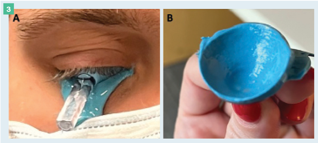 Figure 3.Molds of the Eye. The EyePrintPro is a custom molded technology that uses a custom polymer to take a precise mold of the eye and the lenses are designed through Elevation Specific Technology. Customizations include asymmetric small and large lens diameters, channels, fenestrations, higher order aberration (HOA) correction, prism, multifocal optics, and more. (Images courtesy of Maria K. Walker, OD, PhD.)