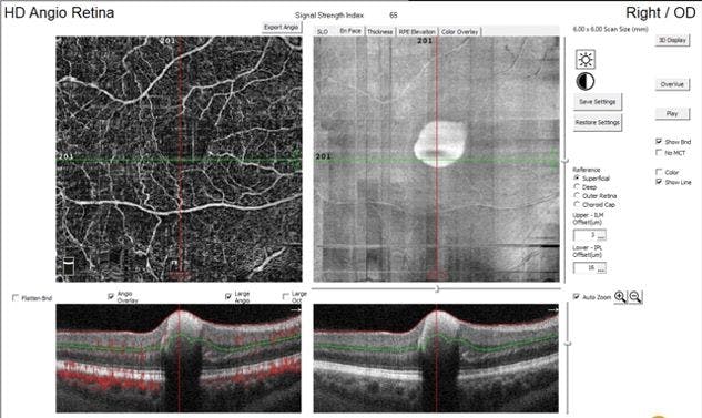 Figure 4. OCT-A of the right eye. Top row: Superficial capillary plexus and reflectance image.   Bottom row: OCT-A cross sections showing circulation (red) in the retinal and capillary circulatory systems (left panel), but stagnation of blood within the hemorrhage.  