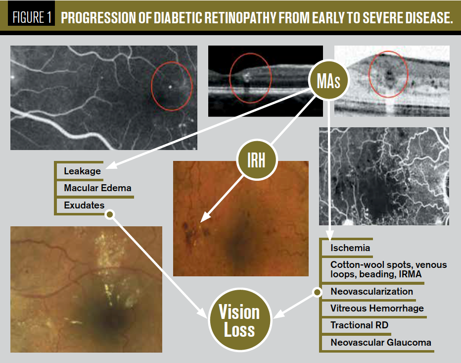  Case report: Don’t be misled by diabetic retinopathy