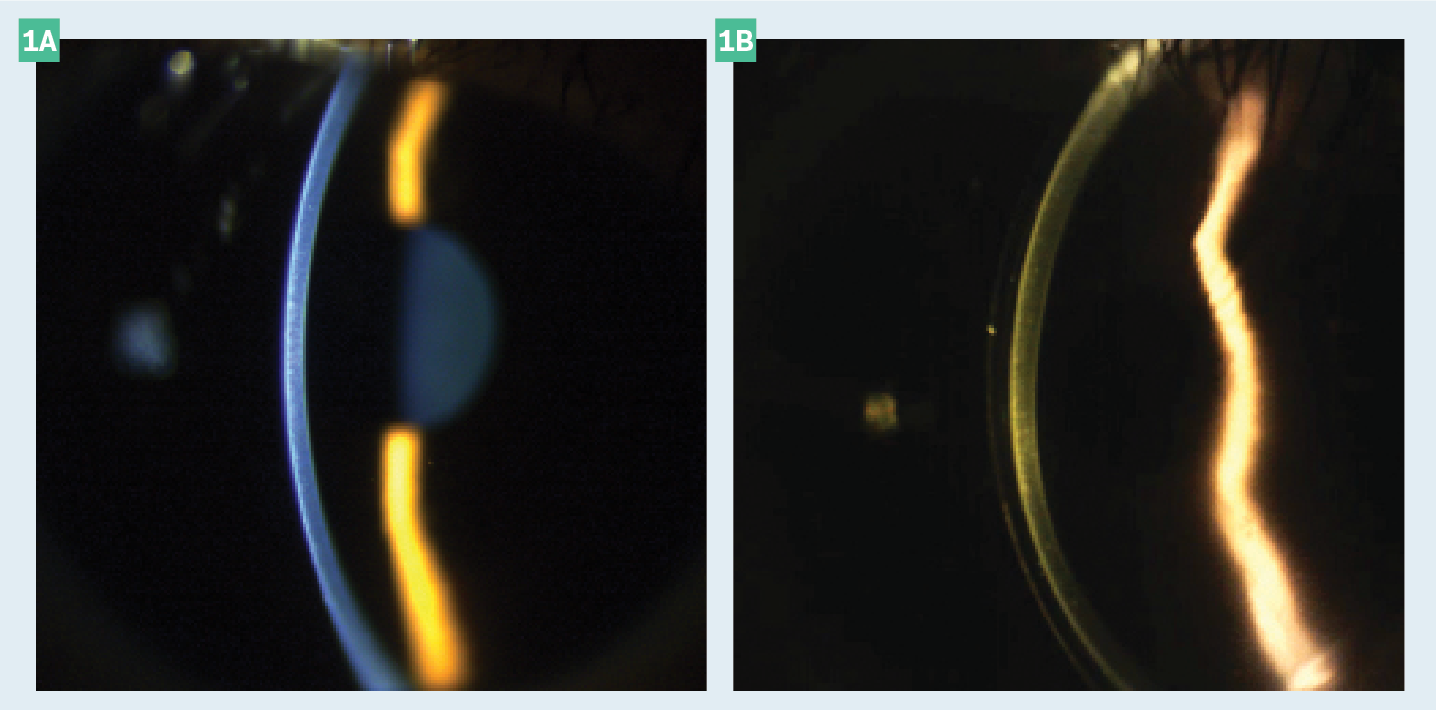 Figure 1. Anterior Chamber. The depth of the anterior chamber (AC) can be estimated with a slit lamp using an optic section technique analogous to the Van Herick angle estimation. A gross estimation is sufficient and a lens with a relatively low, average, or high sagittal (SAG) value can be chosen. A relatively shallow SAG (A) will be about a 1:4 ratio or less and require a lower relative SAG, and a deeper AC (B) (eg, deeper than about 1:6 ratio) will require a deeper SAG lens.

Abbreviations: AC, SAG