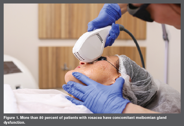 IPL laser is used on a woman's face